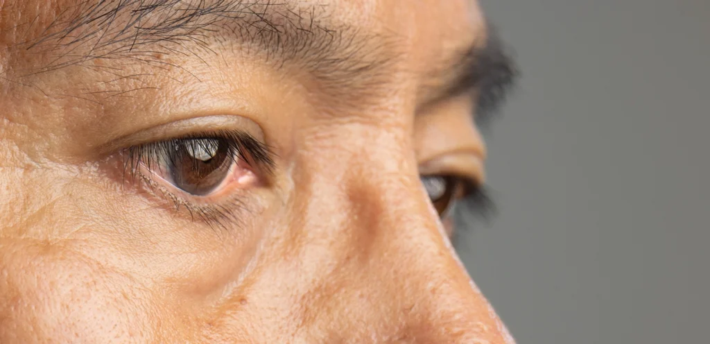 Can Myopia Cause Cataracts