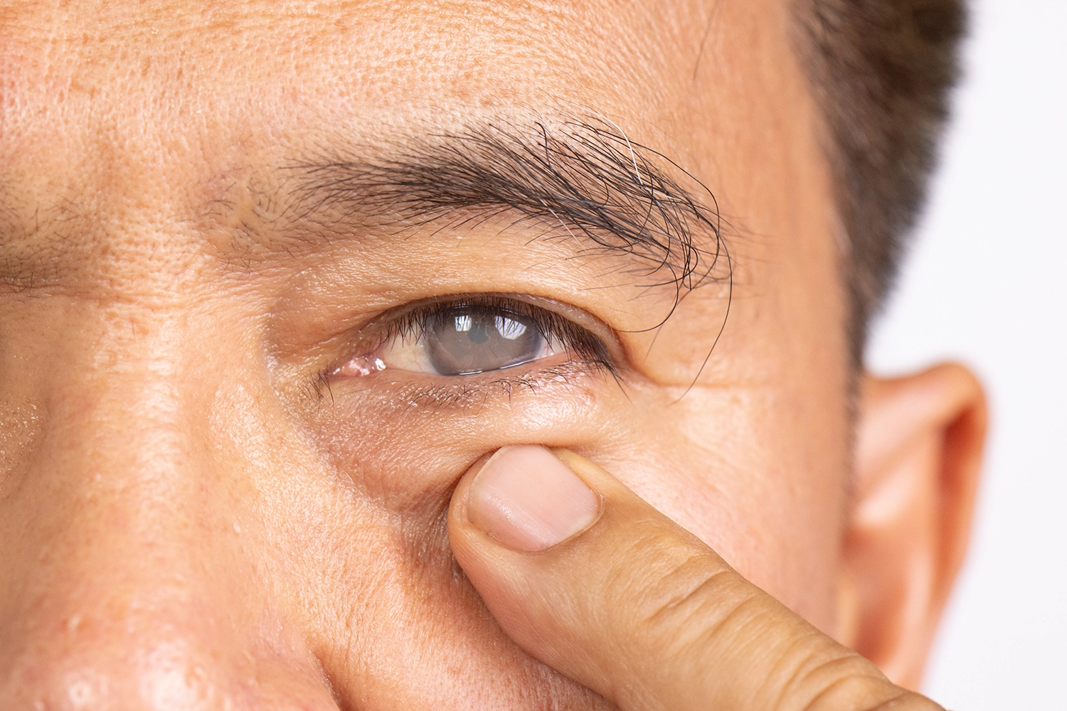 Plenty of people develop a cataract well before old age. Here is how diabetes, steroids and sunlight speed it up, and when to see an eye specialist.